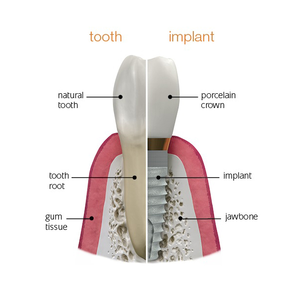Tooth and Implant Difference